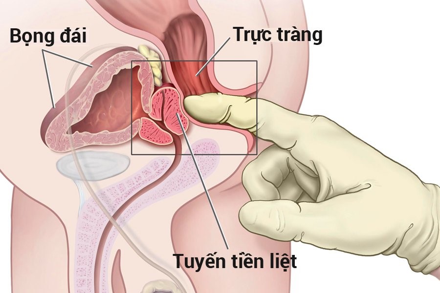 Chỉ số PSA và fPSA trong chẩn đoán ung thư tiền liệt tuyến